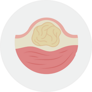 Lipoma Removal