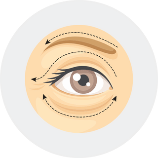 Blepharoplasty Surgery