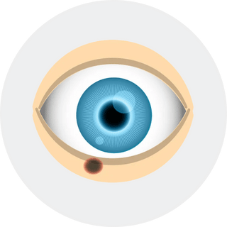 Eyelid Cancer Removal
