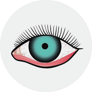 Ectropion Repair