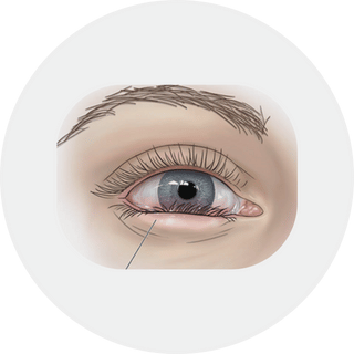 Entropion Repair
