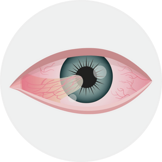 Pterygium Removal