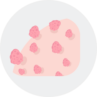 Mole & Skin Tag Removal
